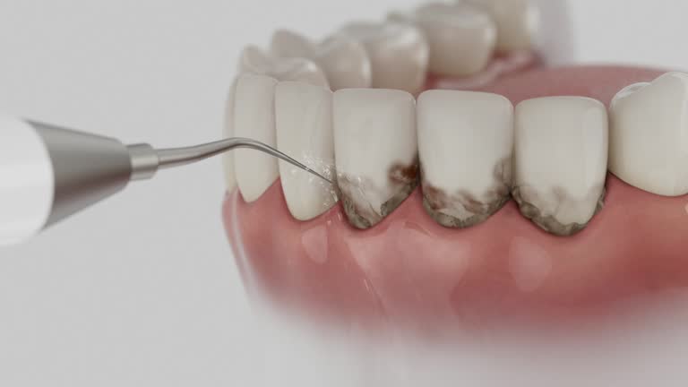 Trusted Wisdom Tooth Removal service in Auburn, CA - Dentist Open Now